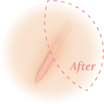 消疤照護系列Scar Care