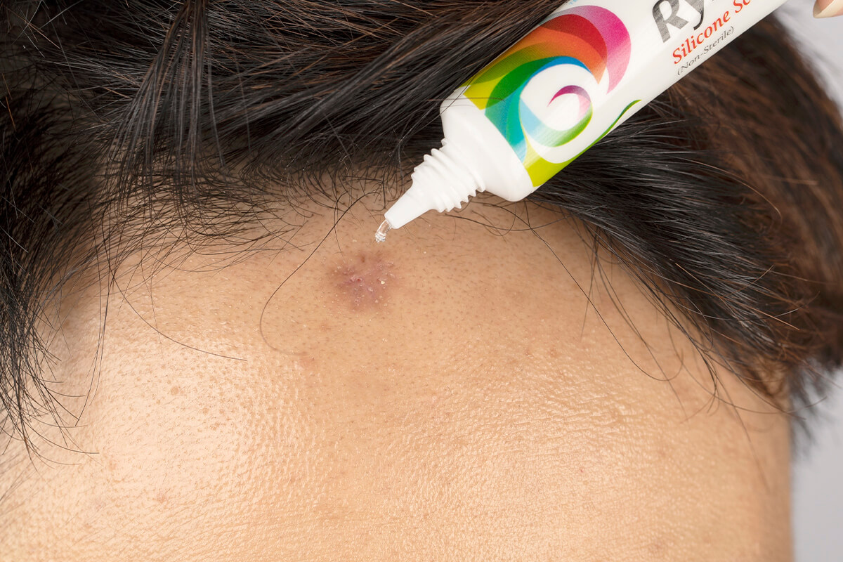 疤痕護理凝膠 美得膚疤痕凝膠